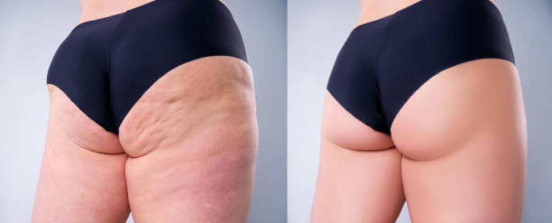 Mesotherapy