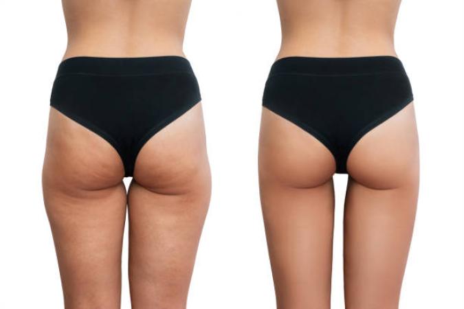 Cavitation 3D