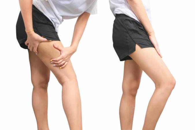 Carboxy Therapy