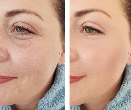 Mesotherapy