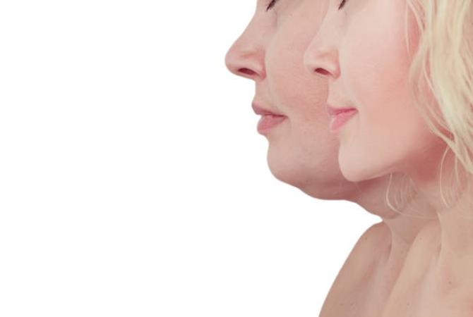 Exilis Elite